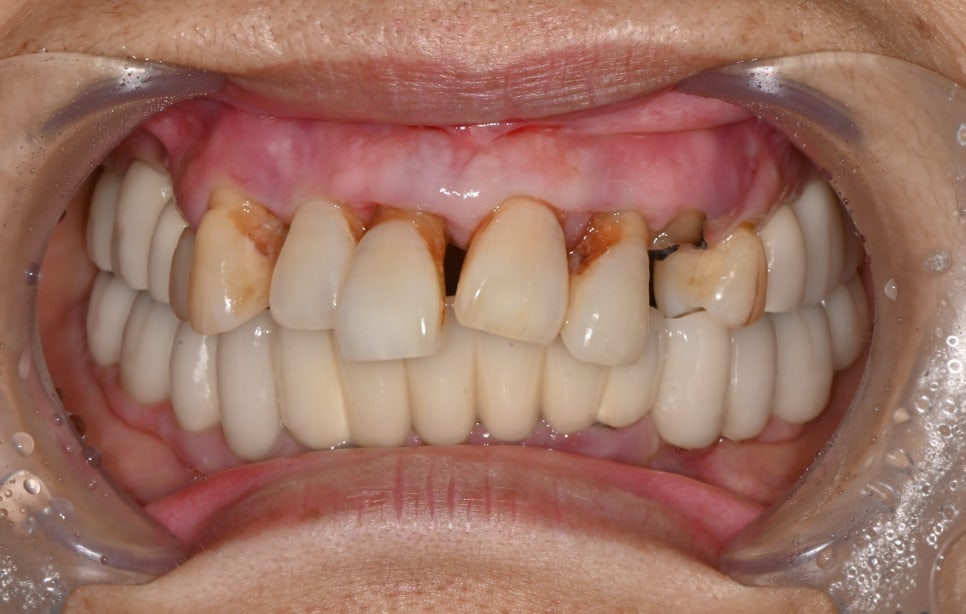 Front Tooth Implant Price: This Is How It Is Treated for a Natural Recovery image 13
