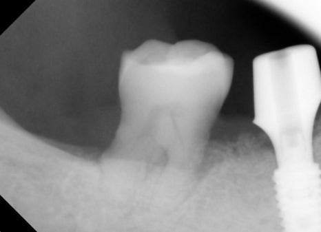 Understanding Implant Price Differences Through the Molar Implant Process image 13