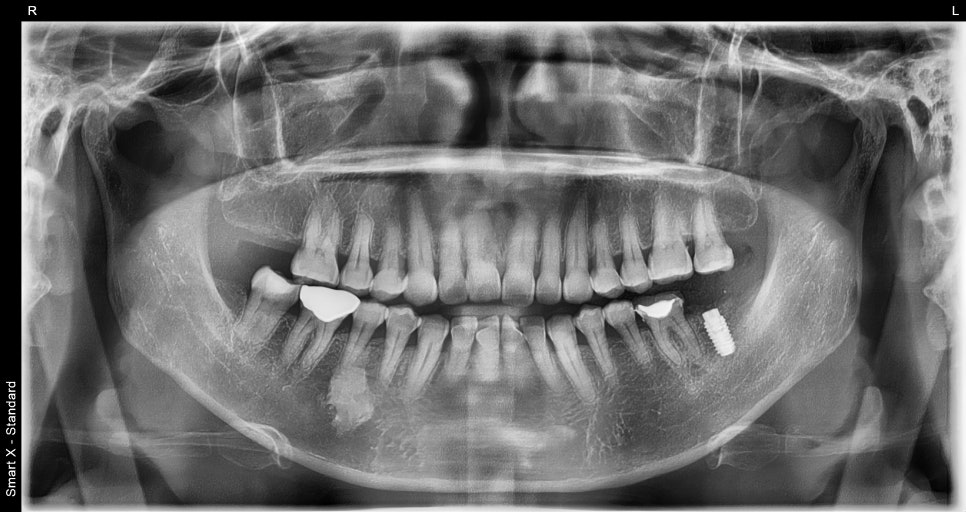 Sammyeon Station Dental Clinic Molars Implant Price, Treatment Process from Extraction to Prosthetics image 4