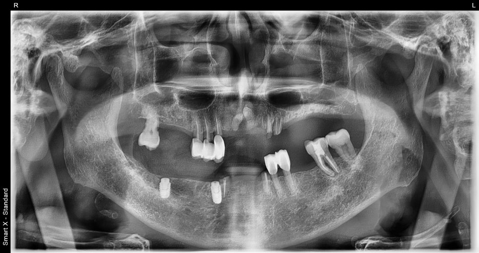 If Your Denture Keeps Coming Loose, What Should You Do? A Real Case Solved with Insurance-Covered Implant Dentures image 6