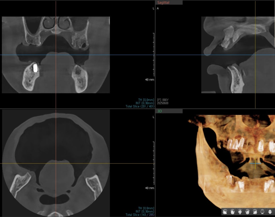 Full-Mouth Implant Price: Treatment for a Patient Over 65 Performed Under Sedation image 5