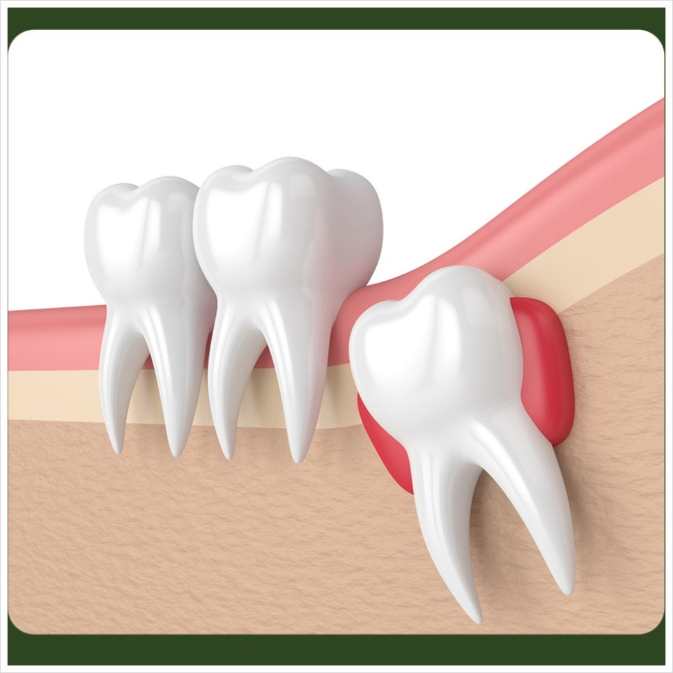 Bad Breath After Wisdom Tooth Extraction: What If It Got Worse After the Extraction? image 5