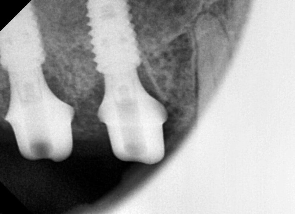 Things You Must Check Before Implant Treatment image 21