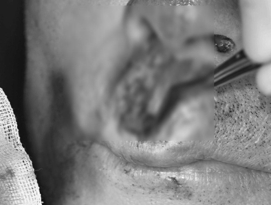 Songpa Dental Clinic: Man in His 70s Fell on Sidewalk Blocks, Requiring Laceration Suturing and Implant Surgery image 5