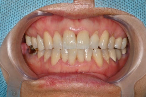 Treatment Process Revealed for a Fall That Injured Both the Front Teeth and Lip image 19