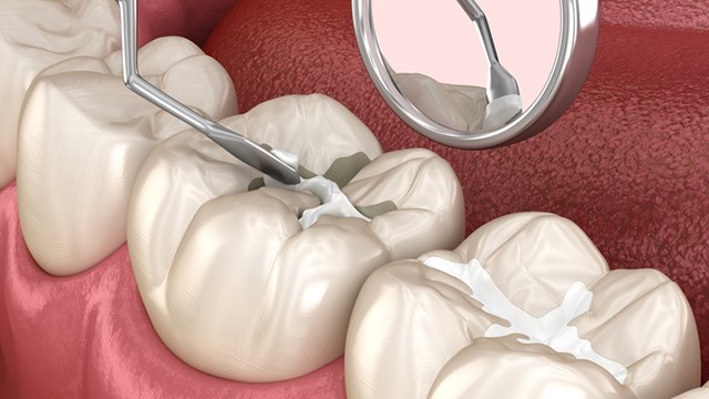 From Cavities to Chipped Front Teeth, Fast and Natural! image 1