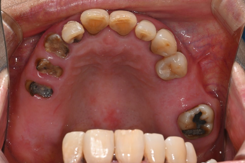Full-Mouth Implant Price: Treatment for a Patient Over 65 Performed Under Sedation image 4