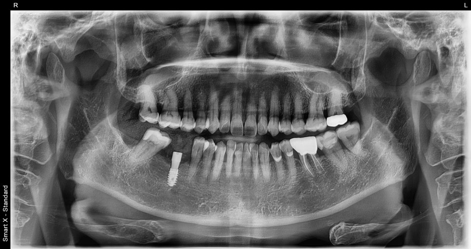 Songpa-gu Implant: Surgical Case of a Foreign Woman in Her 50s (feat. Foreigners’ Dental Clinic) image 4