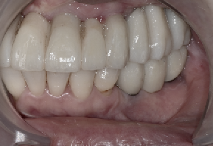 Full-Mouth Implant Price: Treatment Review of a Patient in Their 60s Who Restored Damaged Teeth image 11