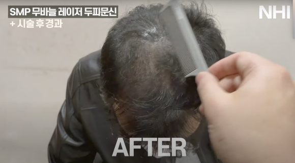 정수리 탈모 두피문신 후기(사진) 보기 l 빗질 영상 관련 이미지 2