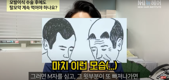 모발이식 후 약 먹어야 할까요? 관련 이미지 9
