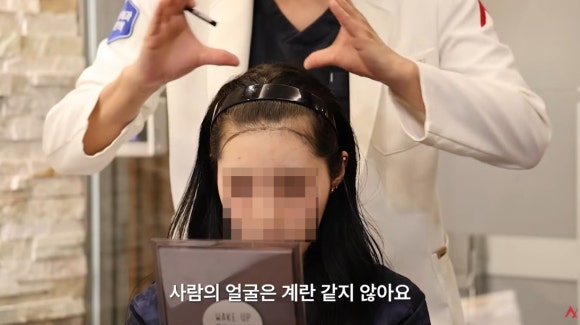 Women’s Hairline Correction: Design Points More Important Than Lowering the Forehead image 3