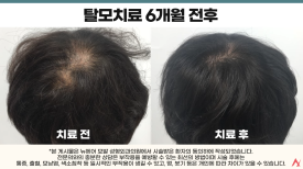 탈모주사치료 후 중단해도 될까? 효과는 유지될까? 관련 이미지 3