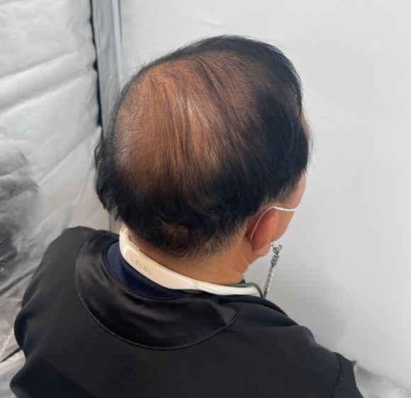 두피문신후기, 60대 남성 사례 전부 공개합니다 관련 이미지 7