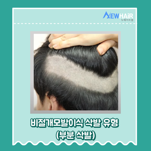 강남비절개모발이식 삭발 유형 알아보기(무삭발,부분삭발,삭발) 관련 이미지 6