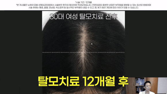 여자정수리탈모, 약 없이 치료하는 법 관련 이미지 1