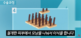 모발이식 절개&middot;비절개보다 중요한 것은? 결과를 좌우하는 5가지 관련 이미지 2