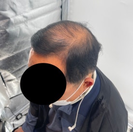 두피문신후기, 60대 남성 사례 전부 공개합니다 관련 이미지 4