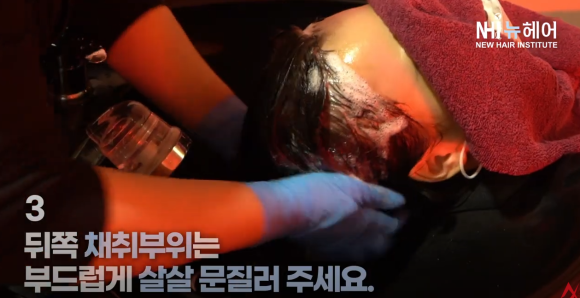 모발이식 후 샴푸(머리감기), 언제부터 가능? 안전하게 머리 감는 방법 관련 이미지 5