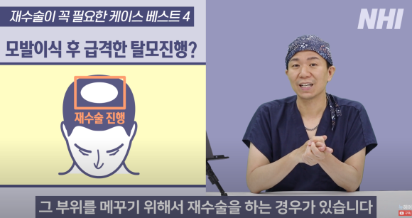 [뉴헤어] 모발이식 재수술하는 경우 정리해드립니다 l  이마축소술 관련 이미지 15