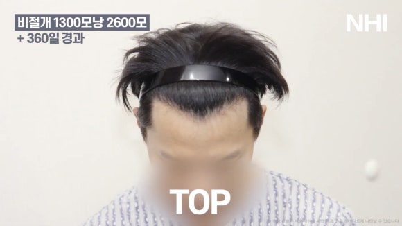모발이식 전후 사진 l 1년 후ㅣ뉴헤어 1300모낭 관련 이미지 4