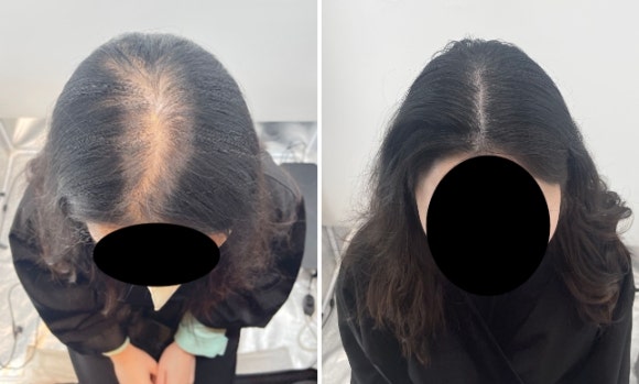 SMP후기, 두피문신 받고 자신감 회복한 30대 여성분 사례 관련 이미지 1