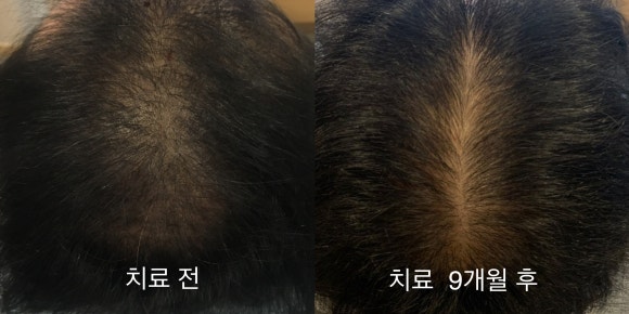 탈모치료(모낭주사) 9개월 결과는? 전후 사진 공개 관련 이미지 1