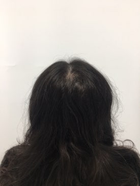 탈모시술 3개월 받은 20대 여성분 실제 사례 공개 관련 이미지 9