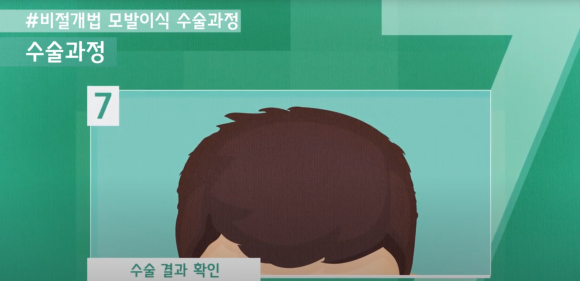 모발이식 수술 뉴헤어에서 알아보기(절개,비절개,헤어라인,모발이식방법,수술) 관련 이미지 15