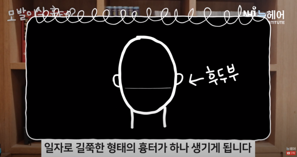 모발이식 흉터 정리 끝! 비절개 & 절개 흉터 비교 관련 이미지 9