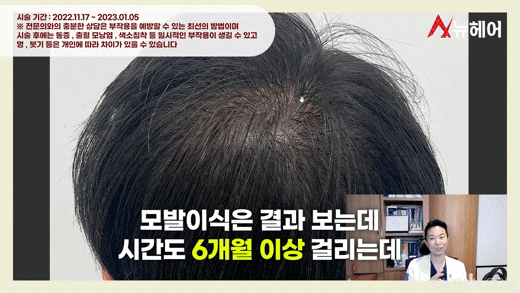 정수리두피문신 리얼 후기! 두피문신은 이런분들에게 추천합니다. 관련 이미지 7