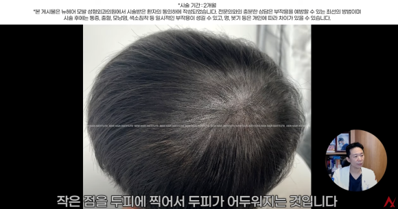 정수리탈모문신 시술직후 나타나는 효과?(전후사진) 관련 이미지 20
