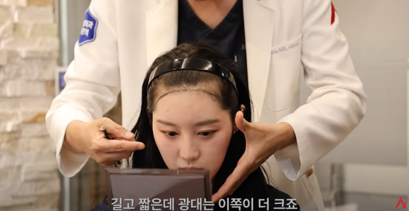 Important Design Points for Hairline Hair Transplantation in Transgender (Gender-Affirming) Patients image 4