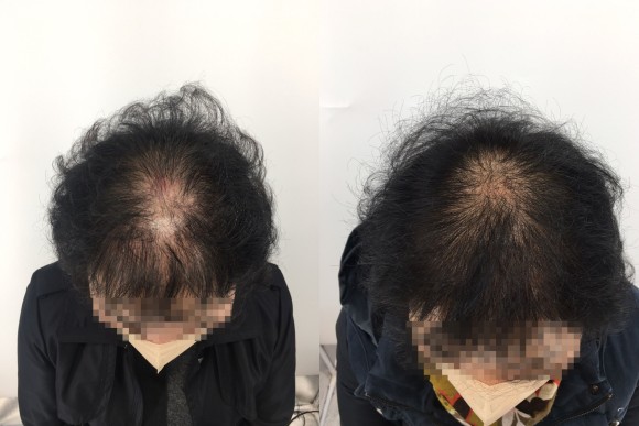 여성탈모치료병원, 관련 이미지 3