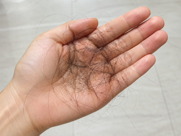 When Is Hair Loss Testing Necessary? Warning Signs and Timing image 6