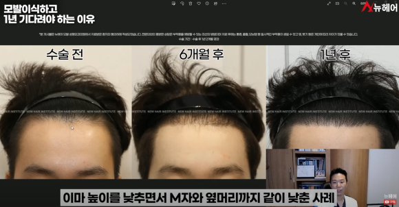 모발이식경과 1년을 기다려야 하는 이유 관련 이미지 6