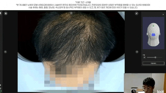 남성 정수리 탈모 치료 수술없이 주사만으로?(탈모약+주사치료) 관련 이미지 11