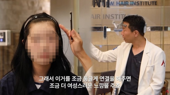 Women’s Hairline Correction: Design Points More Important Than Lowering the Forehead image 2