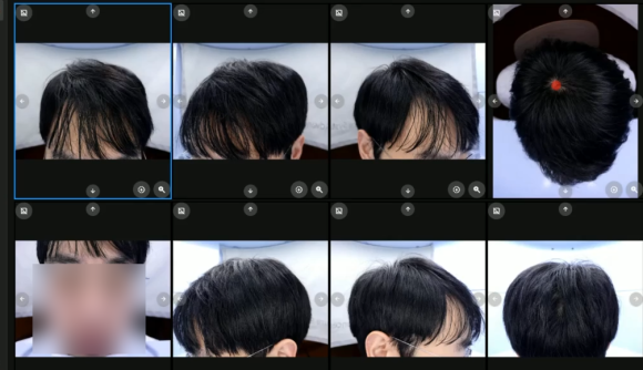 비수술탈모관리, 어떤 과정을 거치게 될까? 관련 이미지 6