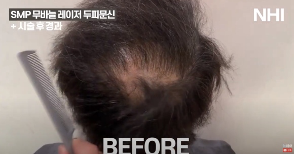 [뉴헤어] 두피문신 전후 빗질 영상 l 정수리 탈모 관련 이미지 3