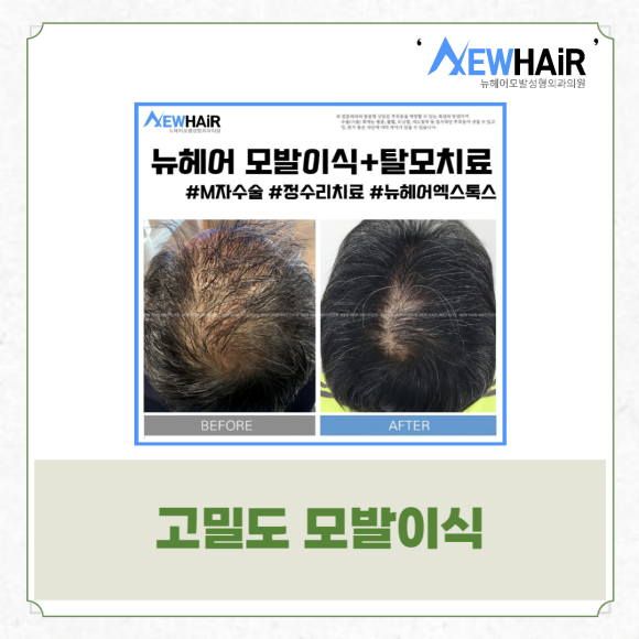 남자헤어라인모발이식 고밀도로 자연스럽게 관련 이미지 4