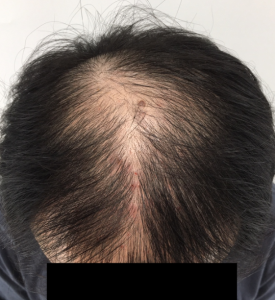 탈모치료주사? 효과 있을까 궁금하신 분들만 보세요 관련 이미지 2