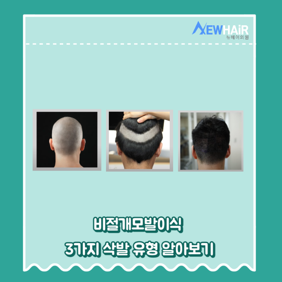 강남비절개모발이식 삭발 유형 알아보기(무삭발,부분삭발,삭발) 관련 이미지 4