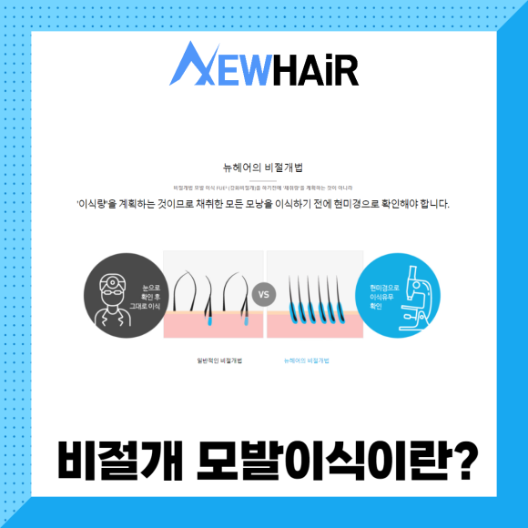 비절개모발이식 고민한다면 관련 이미지 2