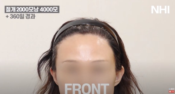 여성 헤어라인교정 2000모낭 절개 1년 후 영상 후기 관련 이미지 3