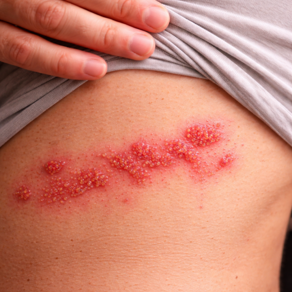 Can Adult Shingles Spread and Lead to Chickenpox in Babies? image 1