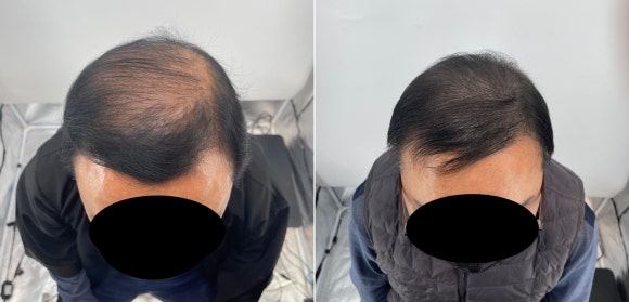 두피문신후기, 60대 남성 사례 전부 공개합니다 관련 이미지 1