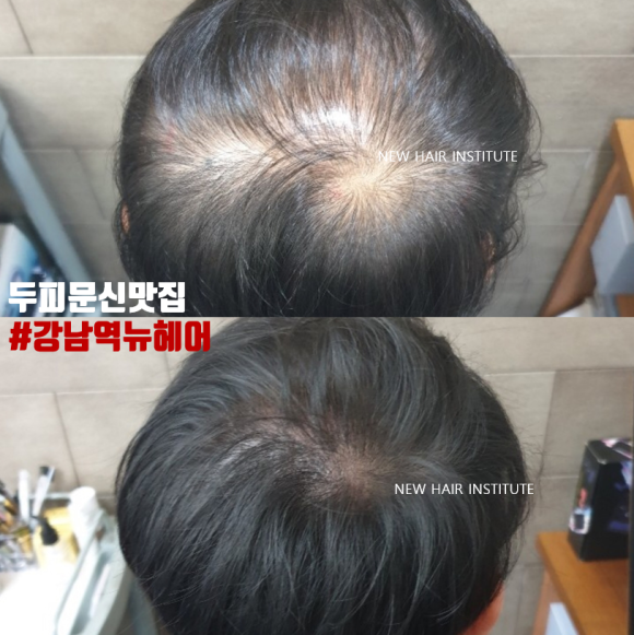 바늘 없이 두피문신을 하는 병원이  있다? 관련 이미지 2