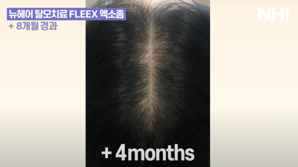 가르마 탈모치료(모낭주사) 8개월 경과 후기 사진 l  탈모치료 관련 이미지 3