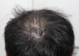 Why Are Crown Hair Transplants (Part-Line Hair Transplants) Slower to Show Results Than Other Areas? image 1